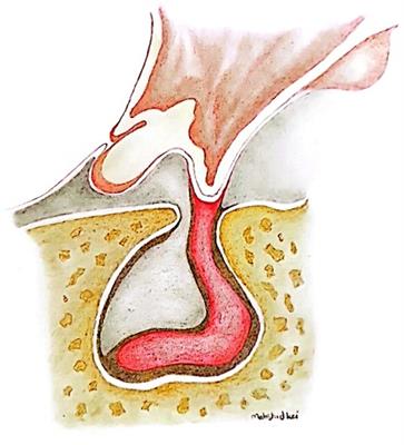 Empty sella in somatotropic pituitary adenomas; a series of 23 cases